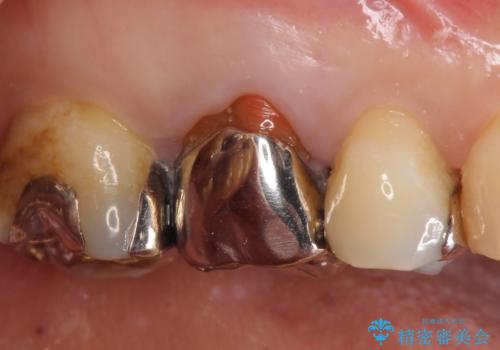 オールセラミッククラウン 銀歯と歯茎の隙間が気になる