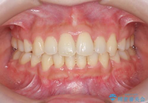 矯正後、オフィスホワイトニングをして、さらに口元を美しく。の症例 治療前