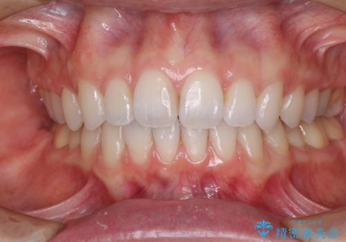 深い咬み合わせと奥歯のむし歯　総合歯科治療の症例 治療後