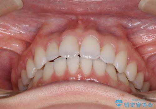 深い咬み合わせと奥歯のむし歯 総合歯科治療の治療後