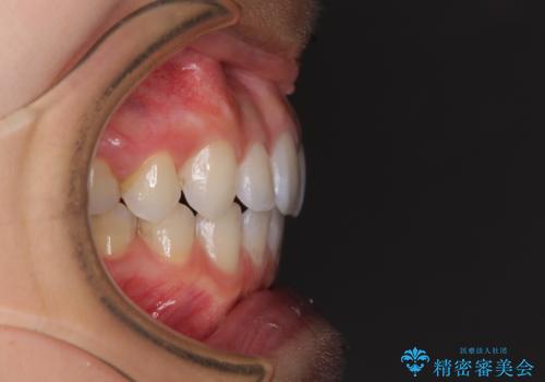 深い咬み合わせと奥歯のむし歯 総合歯科治療の治療後