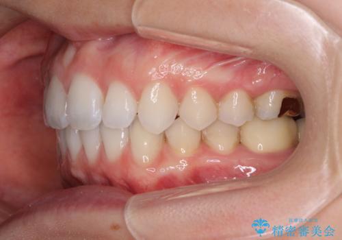 深い咬み合わせと奥歯のむし歯 総合歯科治療の治療後