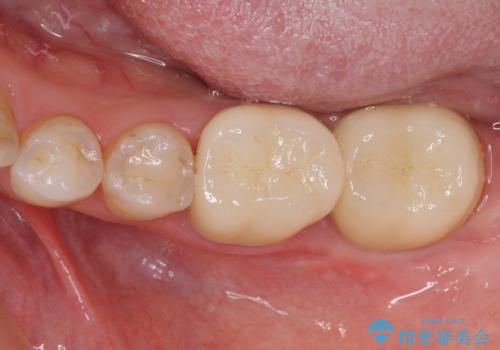 深い咬み合わせと奥歯のむし歯 総合歯科治療の治療後