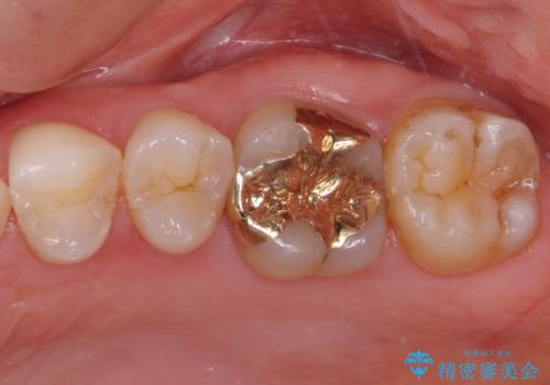 深い咬み合わせと奥歯のむし歯 総合歯科治療の治療後