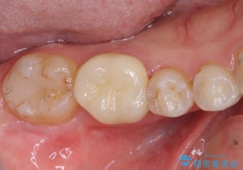 深い咬み合わせと奥歯のむし歯 総合歯科治療の治療後