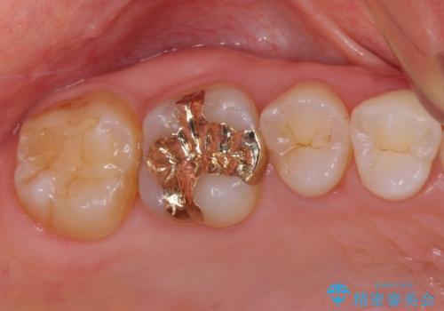 深い咬み合わせと奥歯のむし歯 総合歯科治療の治療後