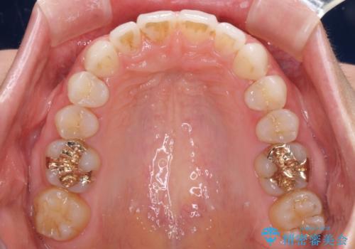 深い咬み合わせと奥歯のむし歯 総合歯科治療の治療後