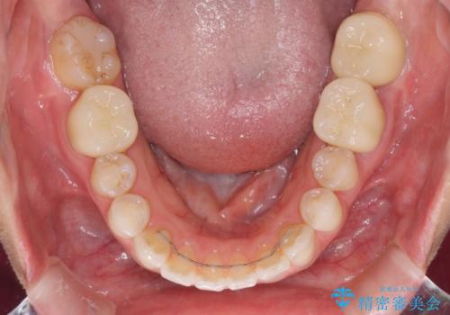 深い咬み合わせと奥歯のむし歯 総合歯科治療の治療後