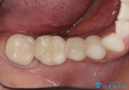 インプラント　抜歯になってしまった歯の補綴の症例 治療後