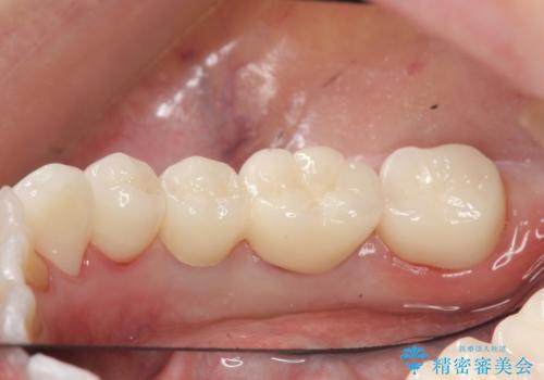 インプラント 抜歯になってしまった歯の補綴の治療後
