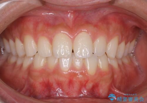 PMTCで前歯のクリーニングの症例 治療前