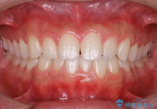 PMTCで前歯のクリーニングの症例 治療後
