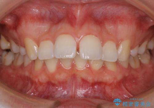 PMTC60分コースの症例 治療前