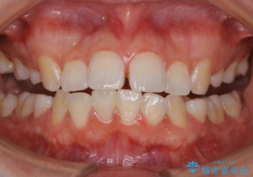 PMTC60分コースの治療前