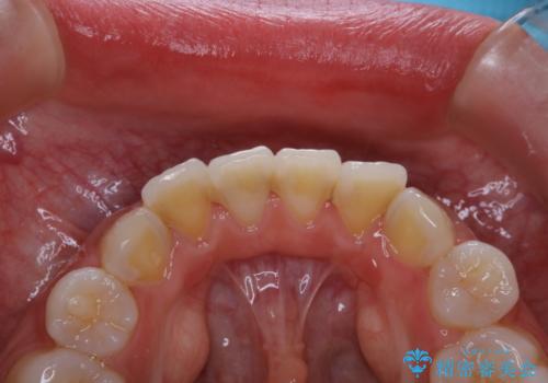 PMTC60分コースの治療前