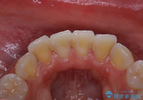 PMTC60分コースの治療前