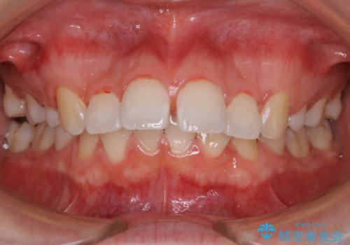 PMTC60分コースの症例 治療後