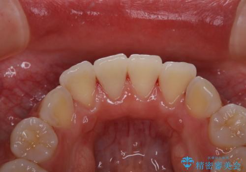 PMTC60分コースの治療後