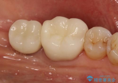 失った歯のインプラントでの咬合回復の治療後