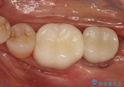 失った歯のインプラントでの咬合回復の治療後