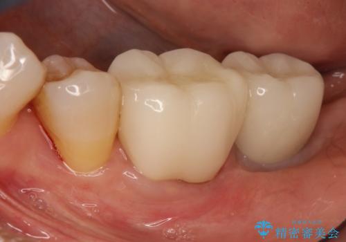 失った歯のインプラントでの咬合回復の症例 治療後