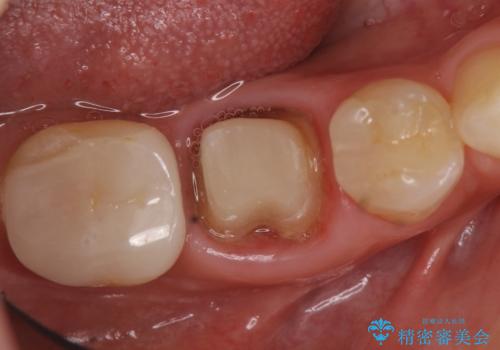 オールセラミッククラウン　他院にて抜歯を勧められた歯の治療の治療中