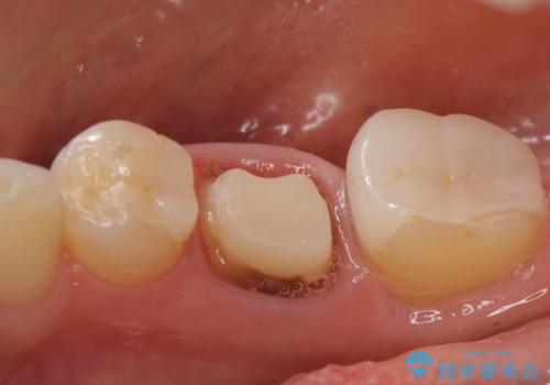 オールセラミッククラウン 他院にて抜歯を勧められた歯の治療の治療中