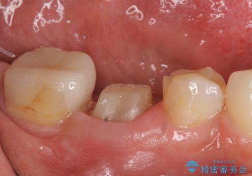 オールセラミッククラウン 他院にて抜歯を勧められた歯の治療の治療中