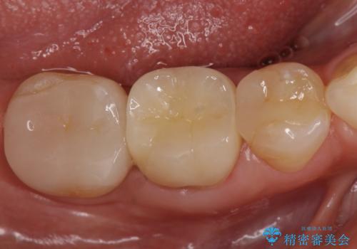 オールセラミッククラウン　他院にて抜歯を勧められた歯の治療の症例 治療後