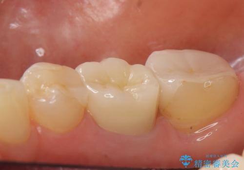 オールセラミッククラウン 他院にて抜歯を勧められた歯の治療