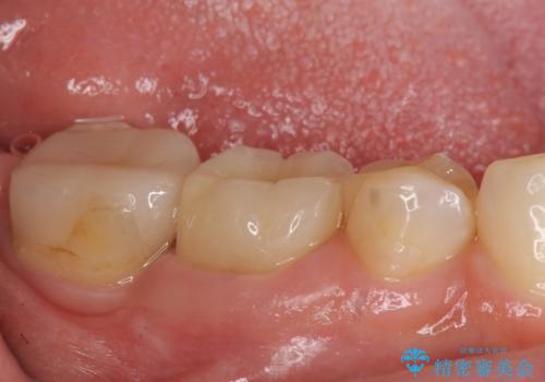 オールセラミッククラウン 他院にて抜歯を勧められた歯の治療の治療後