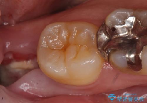 PGA(ゴールド)インレー 深い虫歯の治療の症例 治療前