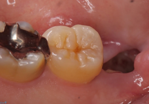 PGA(ゴールド)インレー　深い虫歯の治療の治療前