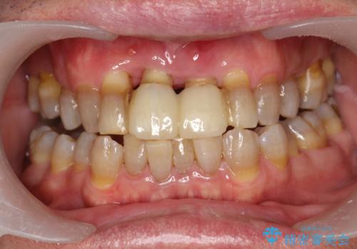 歯周外科前のクリーニングの治療前