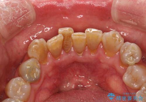 歯周外科前のクリーニングの治療前