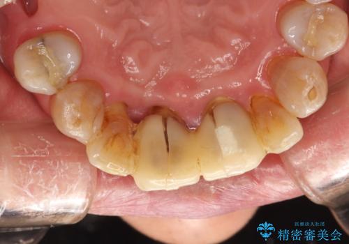歯周外科前のクリーニングの治療前