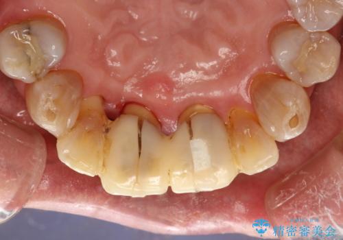 歯周外科前のクリーニングの治療後