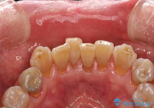 歯周外科前のクリーニングの治療後