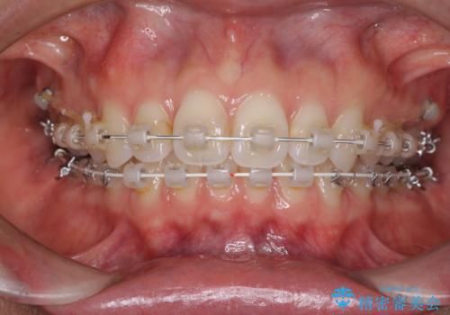 深い咬み合わせと奥歯のむし歯 総合歯科治療の治療中