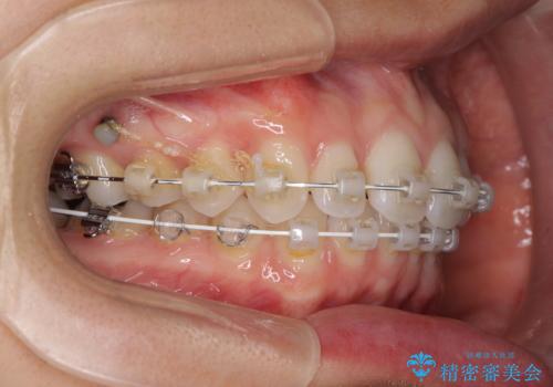 深い咬み合わせと奥歯のむし歯 総合歯科治療の治療中