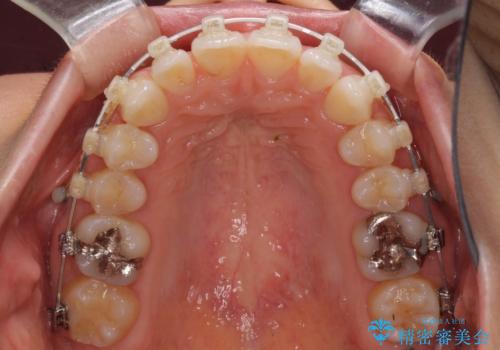 深い咬み合わせと奥歯のむし歯 総合歯科治療の治療中