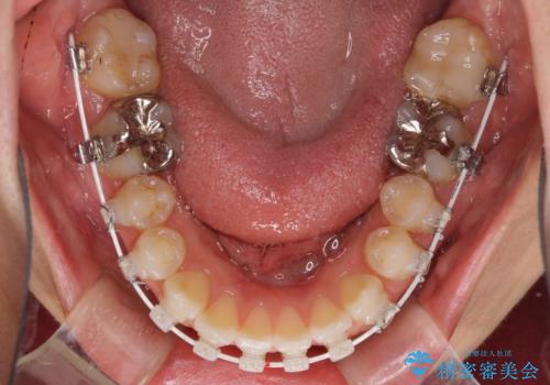 深い咬み合わせと奥歯のむし歯　総合歯科治療の治療中