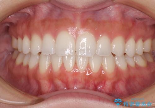 前歯のオープンバイトを治したい インビザラインでの矯正治療の症例 治療後