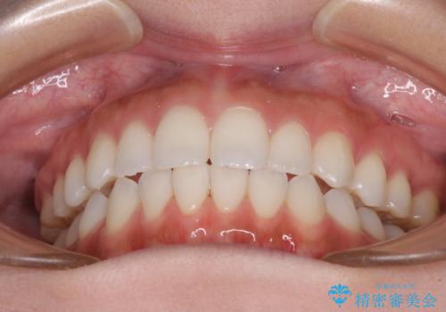 前歯のオープンバイトを治したい インビザラインでの矯正治療の治療後