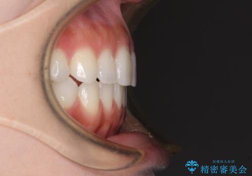 前歯のオープンバイトを治したい インビザラインでの矯正治療の治療後