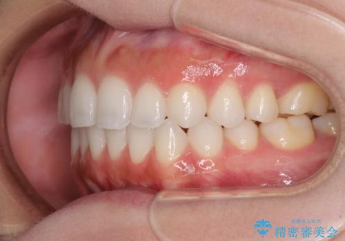 前歯のオープンバイトを治したい インビザラインでの矯正治療の治療後