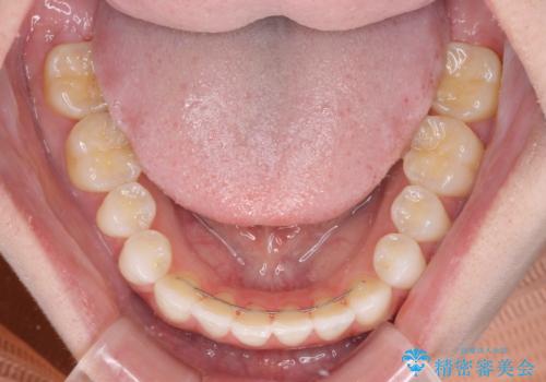 前歯のオープンバイトを治したい インビザラインでの矯正治療の治療後