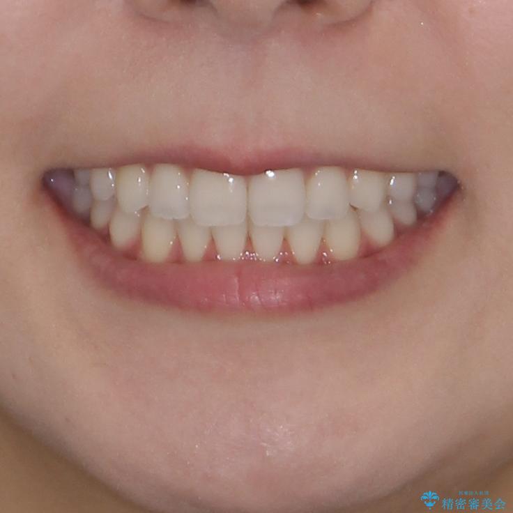前歯のオープンバイトを治したい インビザラインでの矯正治療の治療後(顔貌)
