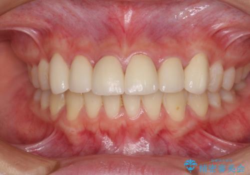 継ぎ接ぎだらけの前歯を綺麗にしたい 前歯のオールセラミックの治療後