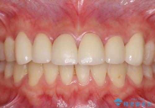 継ぎ接ぎだらけの前歯を綺麗にしたい 前歯のオールセラミックの治療後